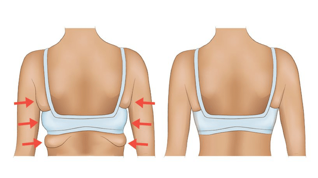 Liposuction of armpit fat (axillary rolls) – a VITAL complement to Plastic  Surgery of the breasts