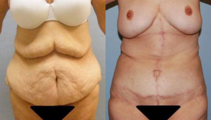 Body Contouring After Massive Weight Loss In Raleigh Nc