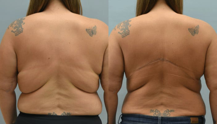 Arm Pit & Bra Bulge Lipo Before & After