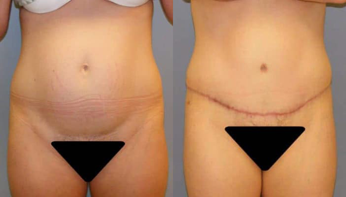 Reveal The Best Combined Treatment Of BBL Surgery & Abdominoplasty!