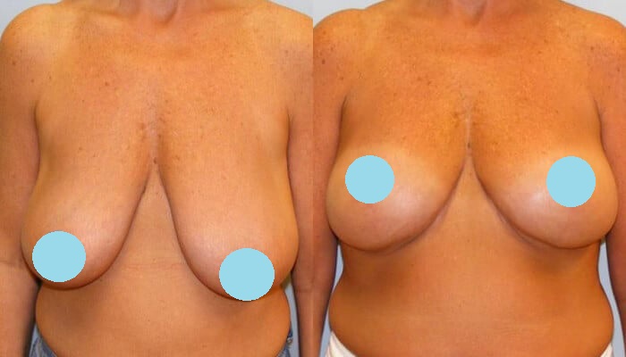 Breast Lift Patient 1 Before and After