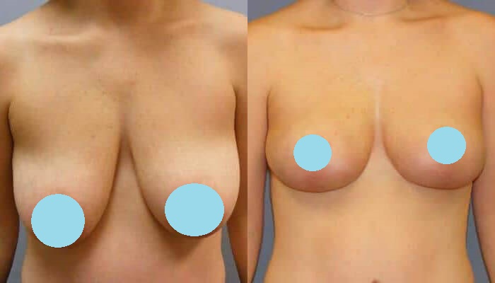 Breast Lift Patient 2 Before and After