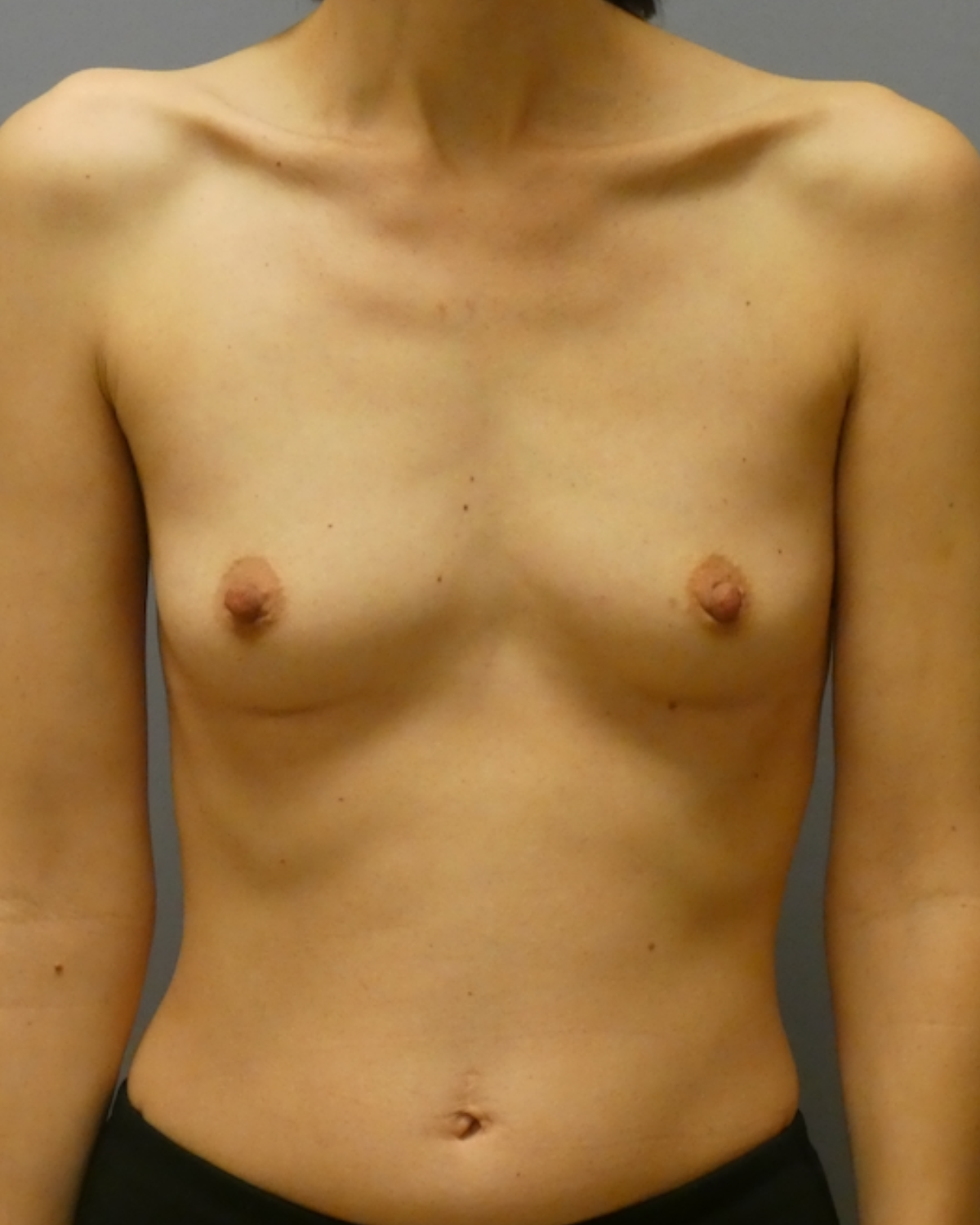 Breast Augmentation Gallery Before Patient 1