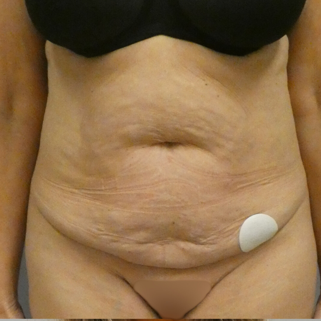 Tummy Tuck Gallery Before Patient 1