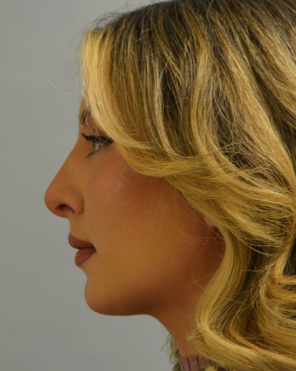 Rhinoplasty Gallery After Patient 1