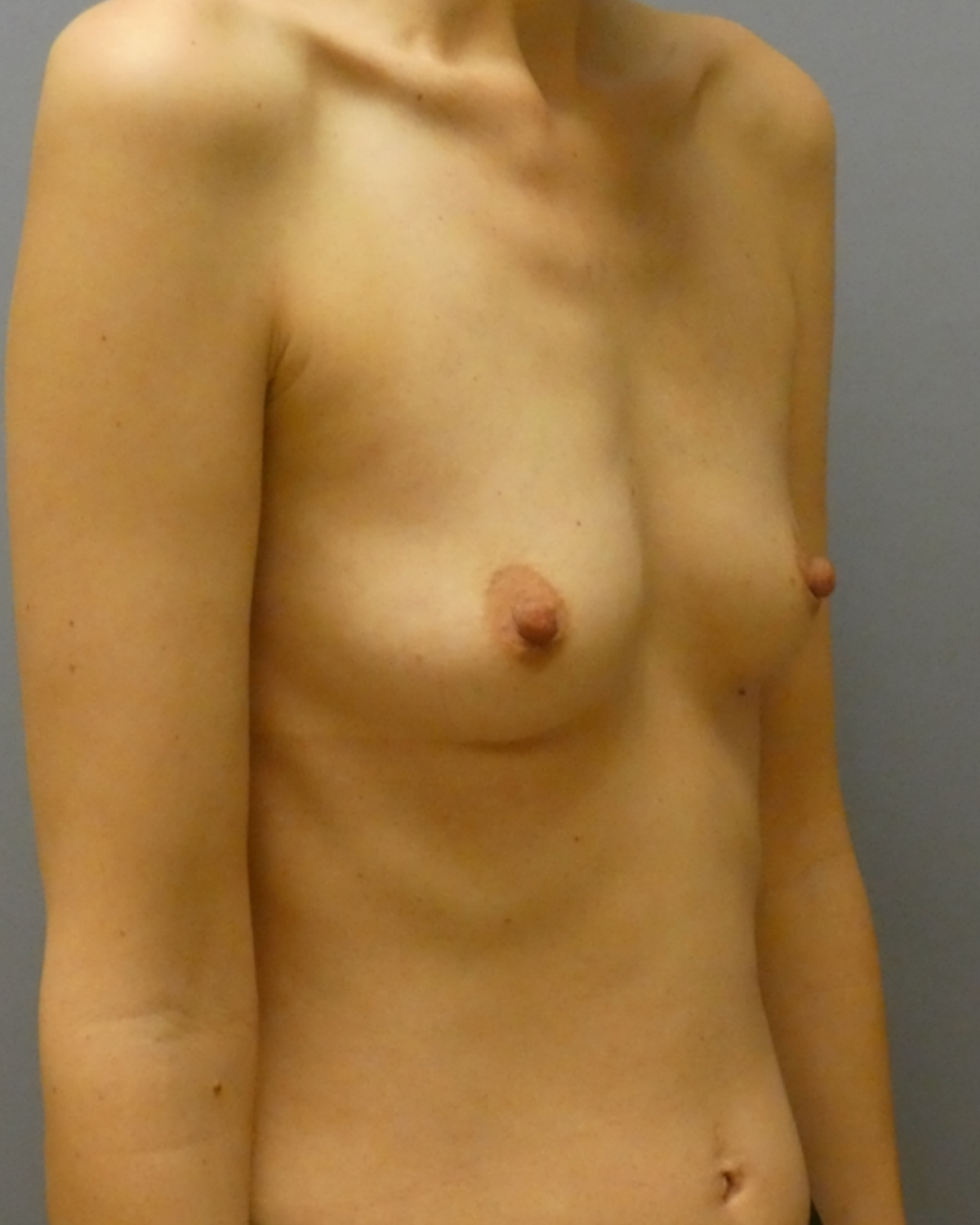 Breast Augmentation Gallery Before Patient 1