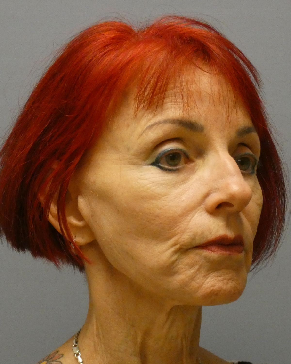Deep Plane Facelift Gallery Before Patient 1