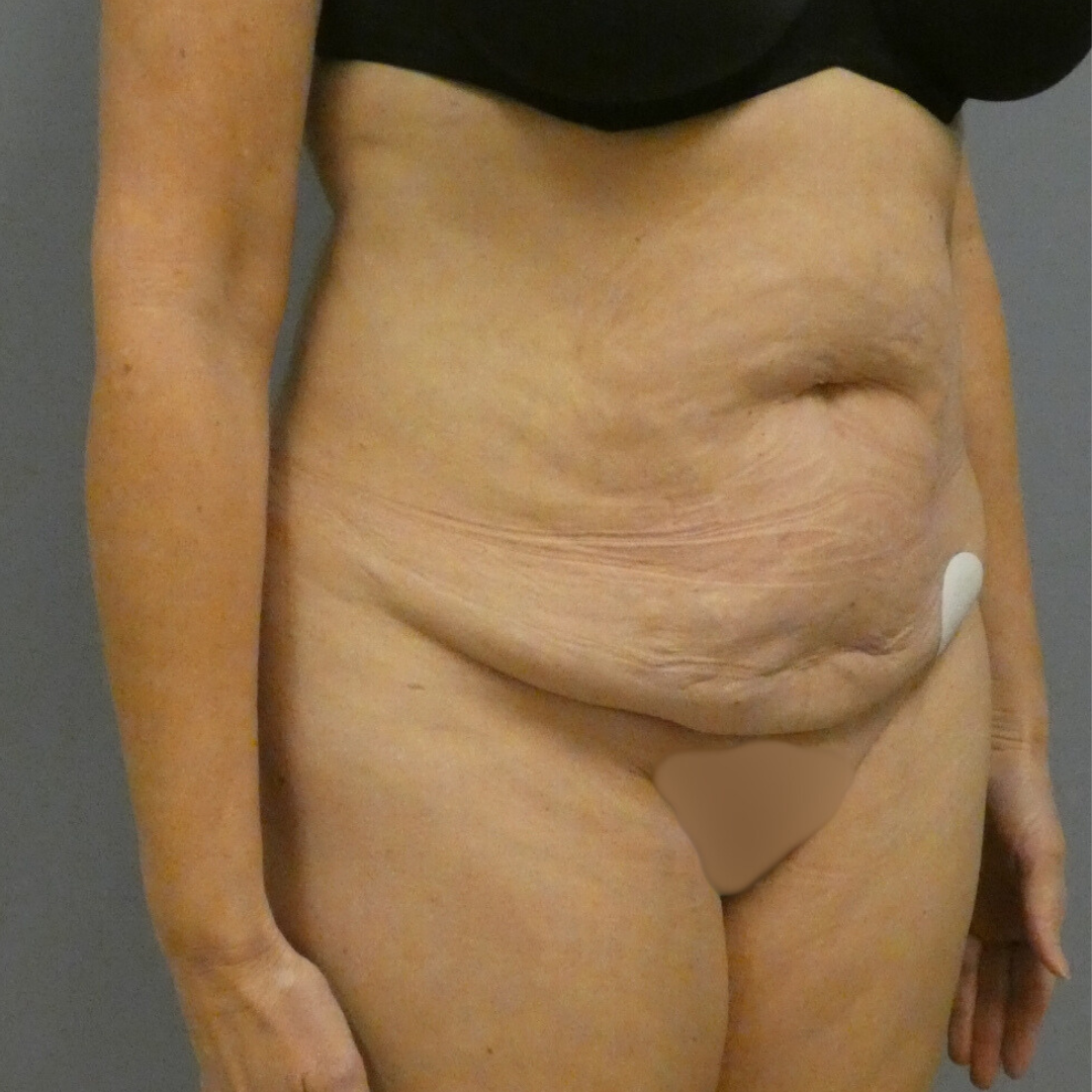 Tummy Tuck Gallery Before Patient 1