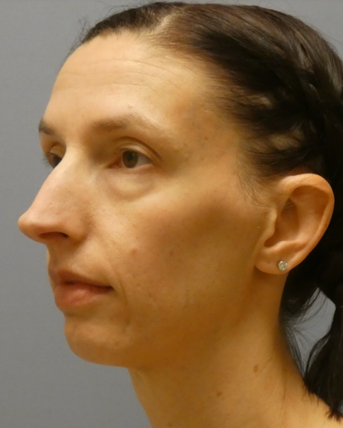 Eyelid Surgery Gallery Before Patient 1