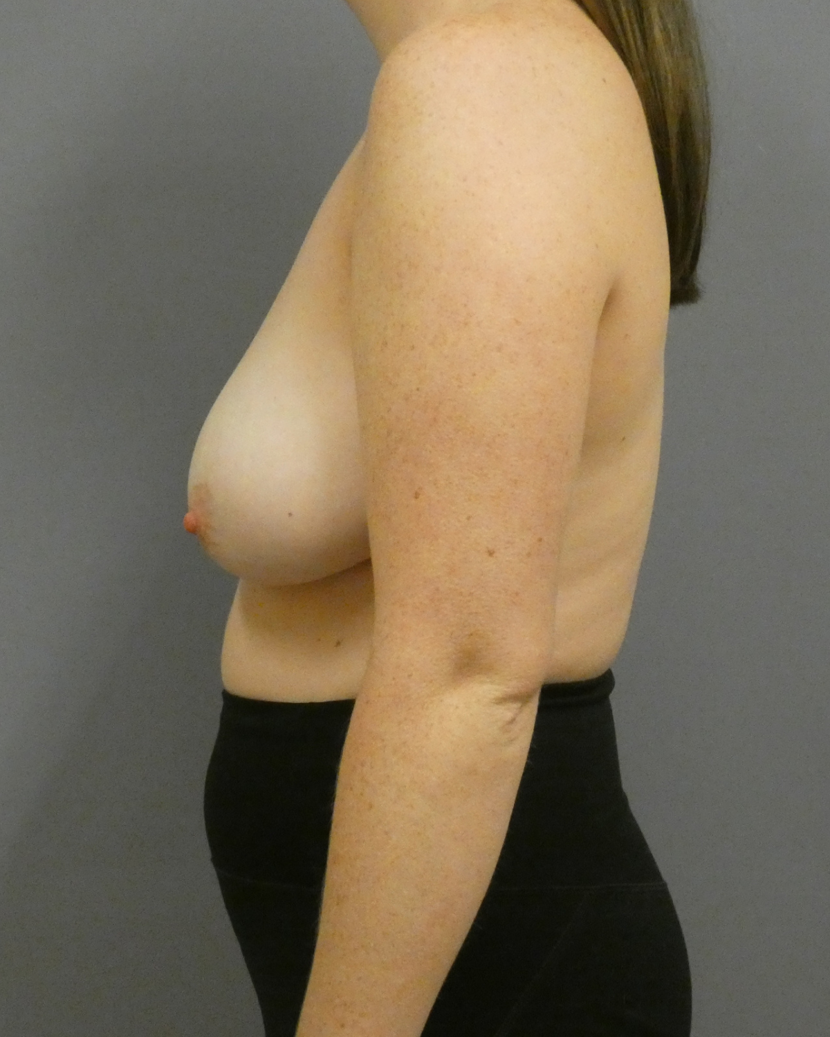 Breast Reduction Gallery Before Patient 1