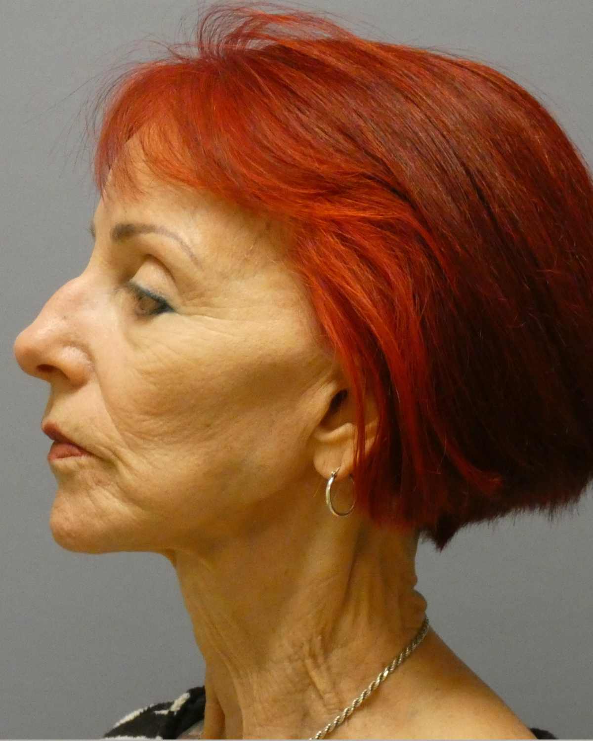 Deep Plane Facelift Gallery Before Patient 1