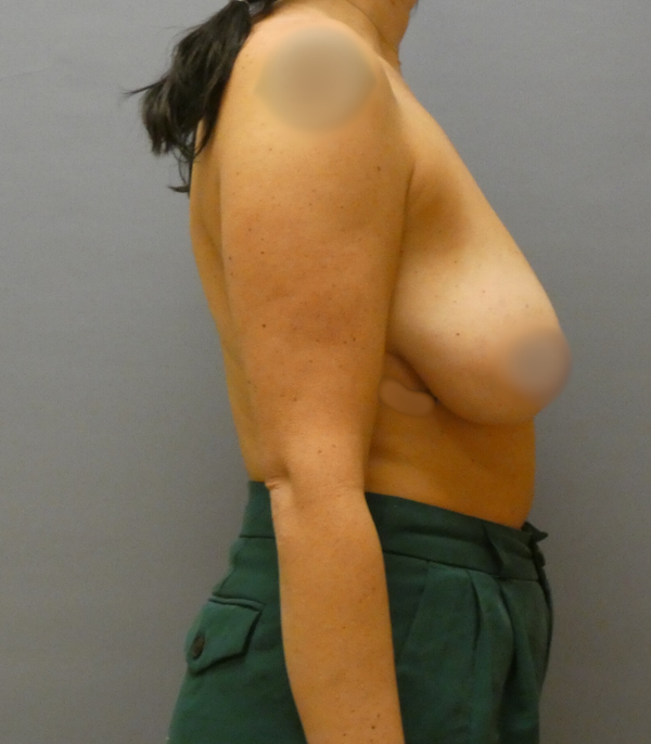 Breast Reduction Gallery Before Patient 1