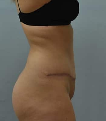 Tummy Tuck Gallery After Patient 1