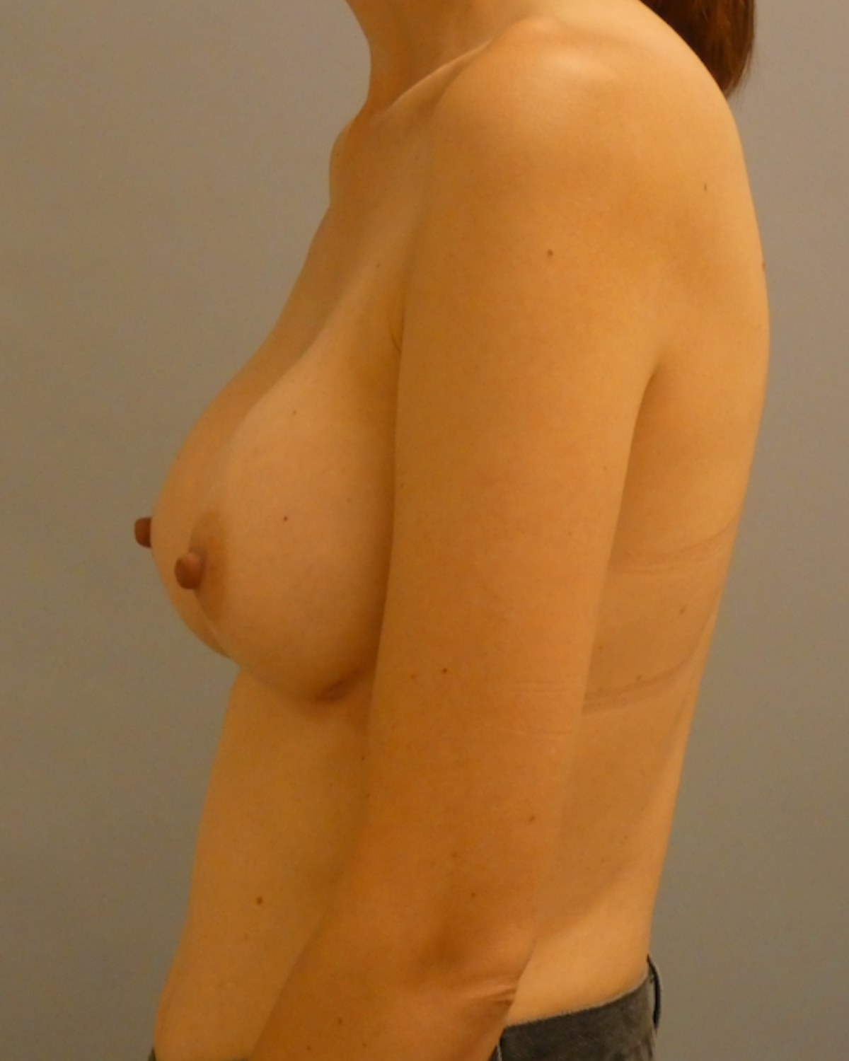 Breast Augmentation Gallery After Patient 1