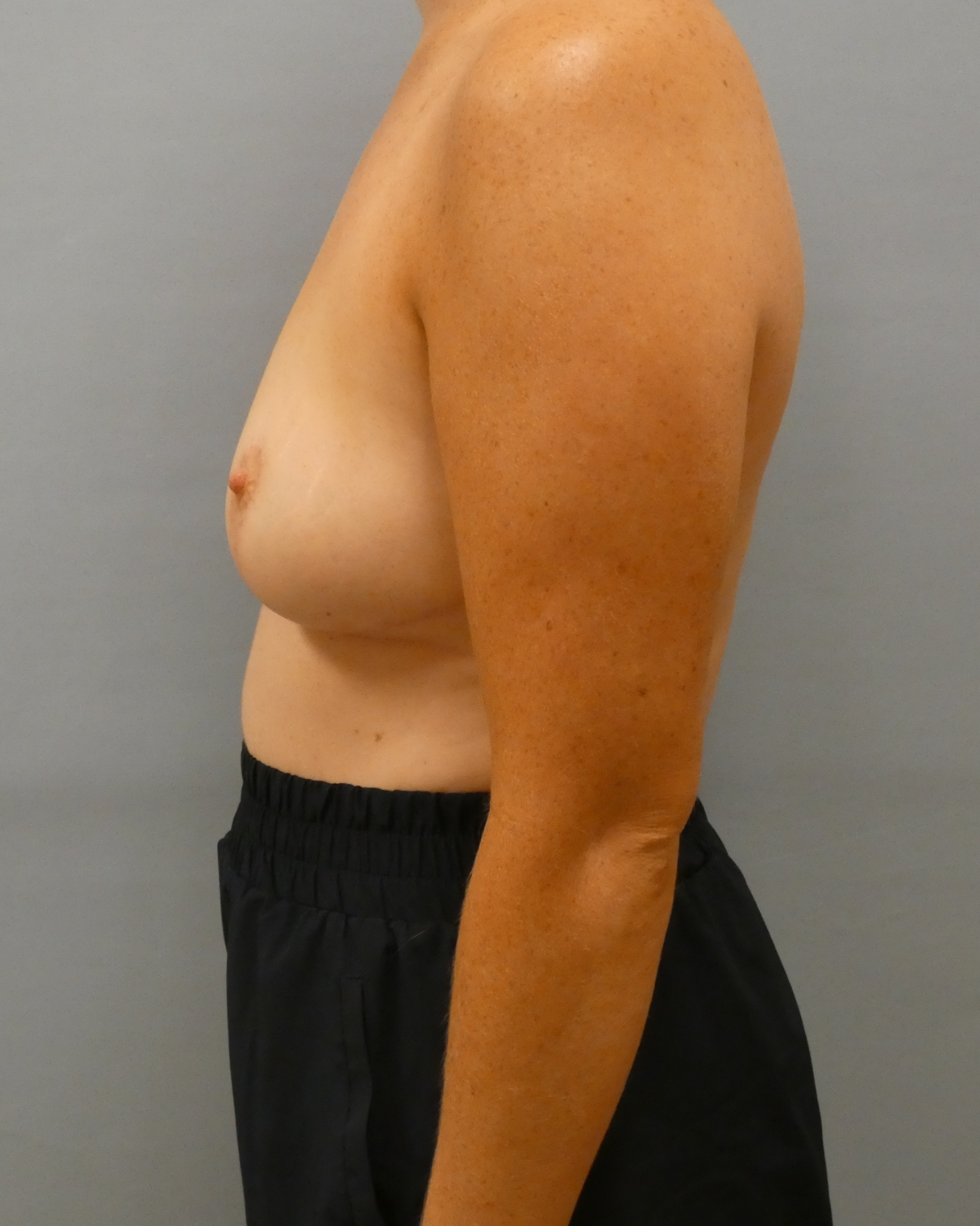 Breast Reduction Gallery After Patient 1