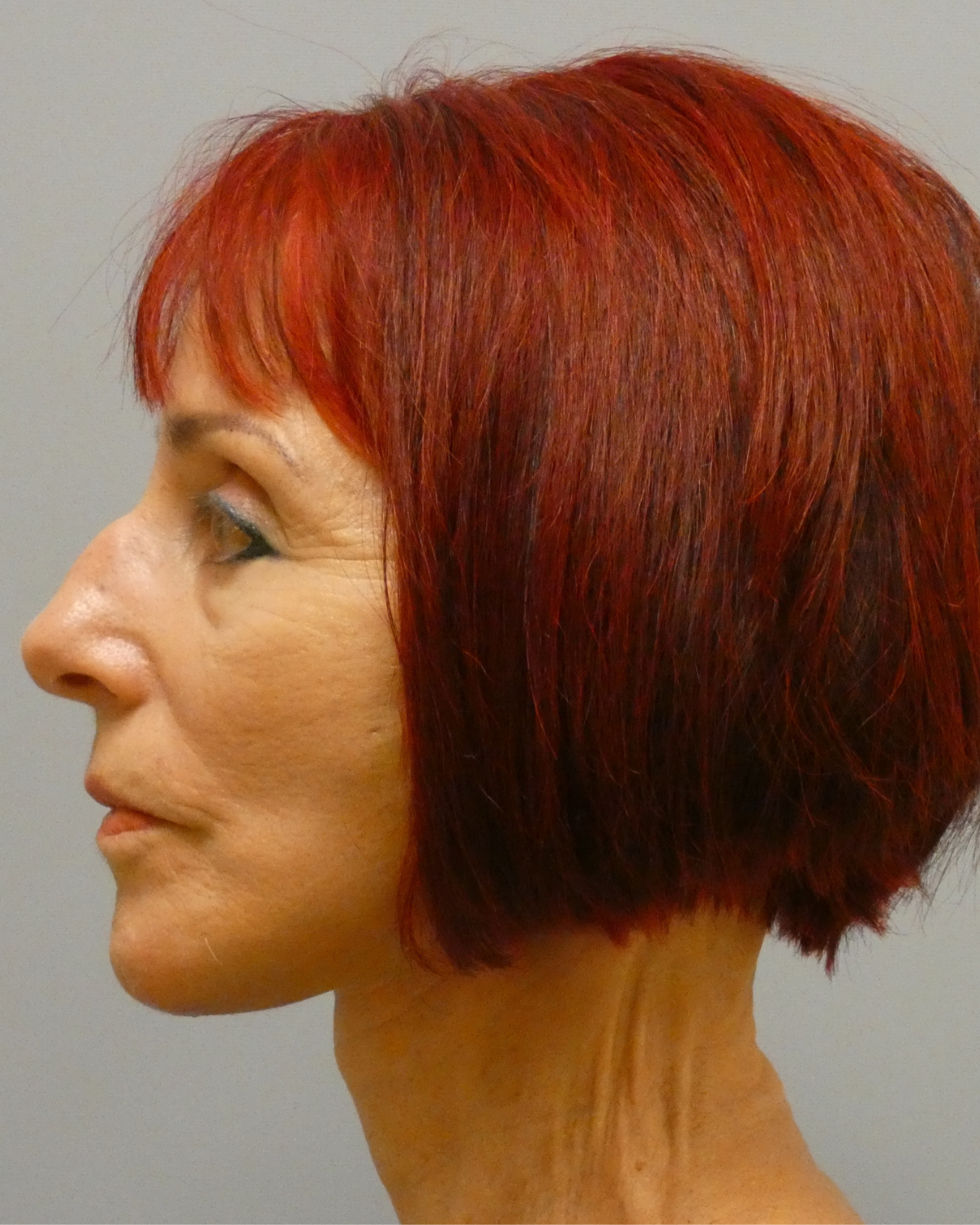 Deep Plane Facelift Gallery After Patient 1