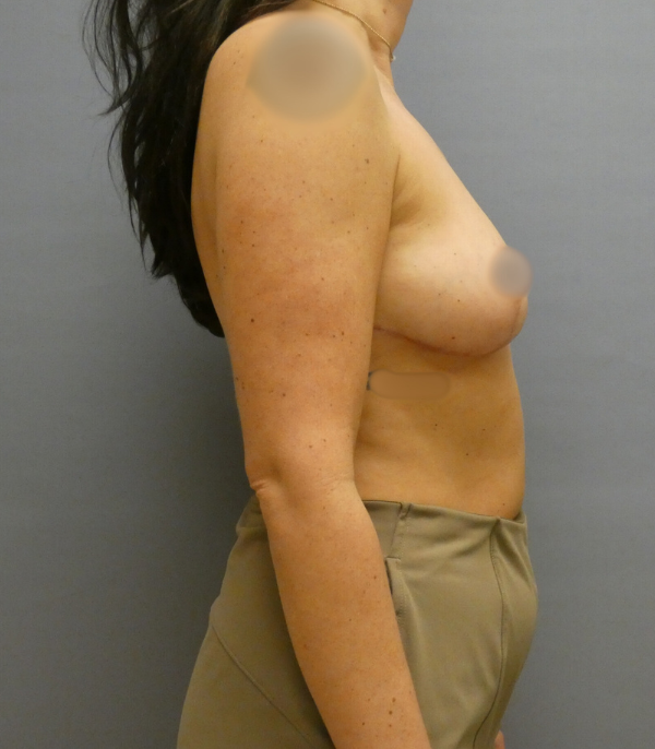Breast Reduction Gallery After Patient 1