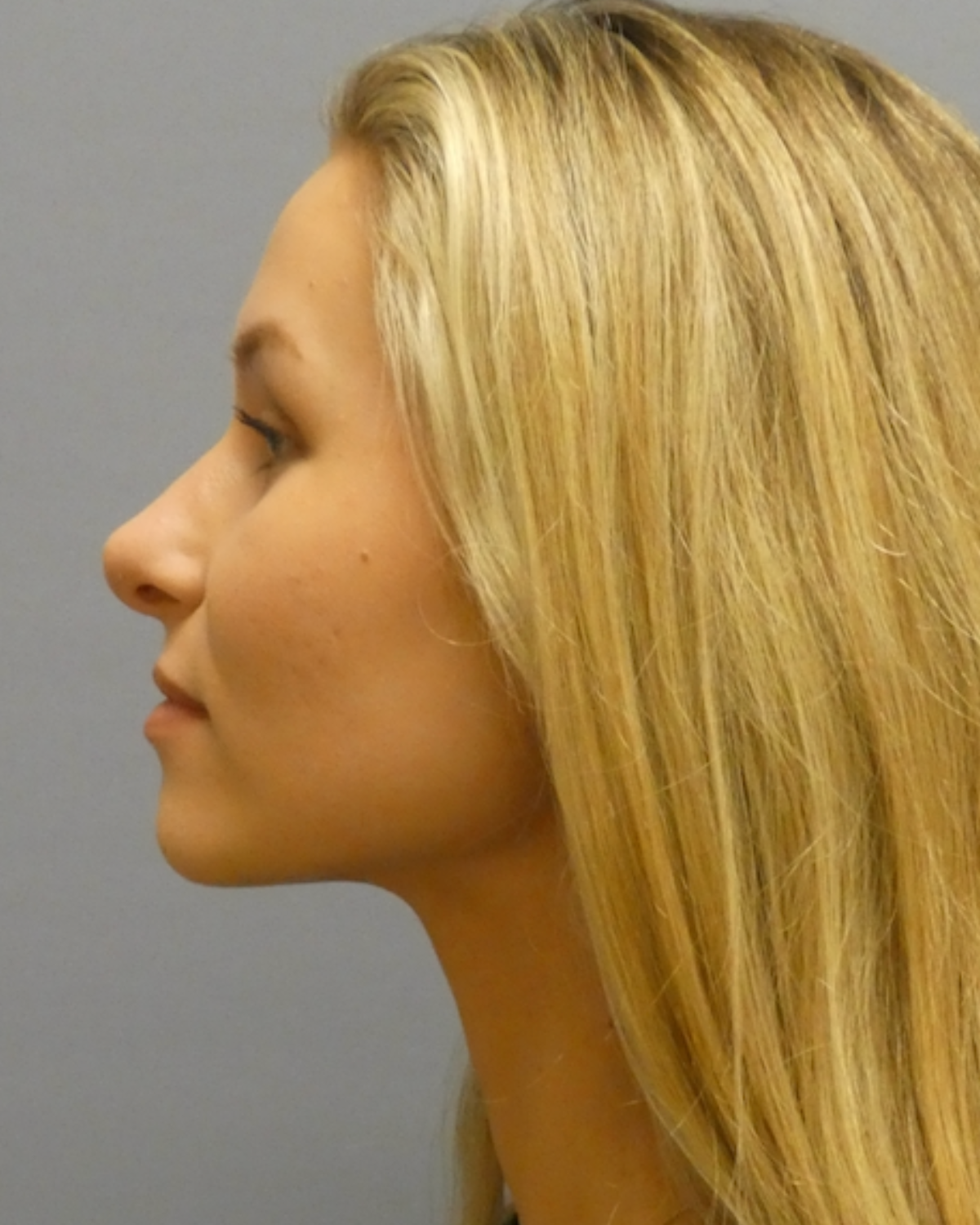 Rhinoplasty Gallery After Patient 1
