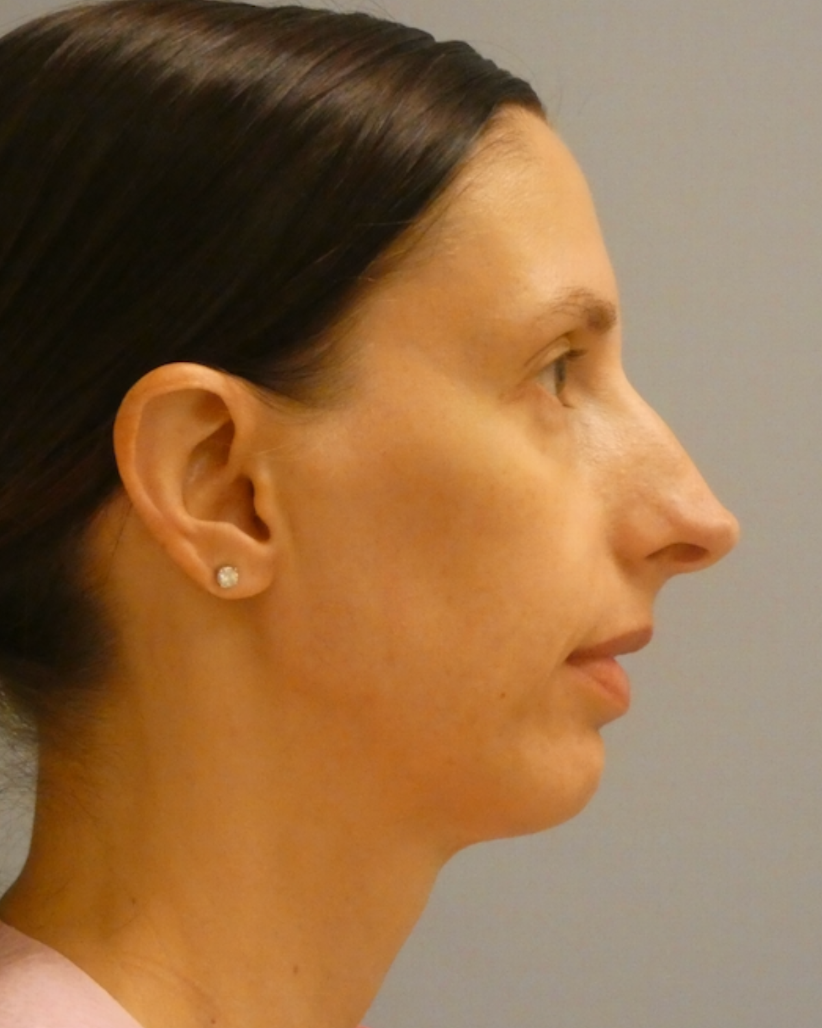 Eyelid Surgery Gallery After Patient 1