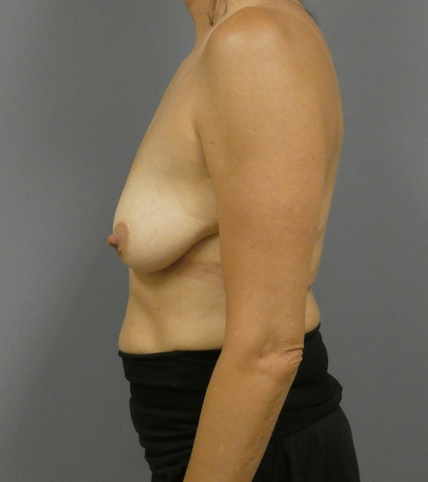 Breast Augmentation with Breast Lift Gallery Before Patient 1